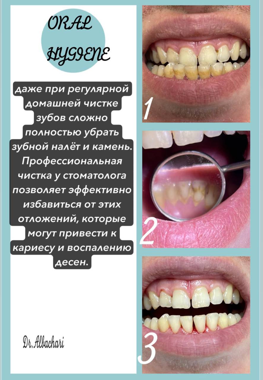 До и после установки коронок