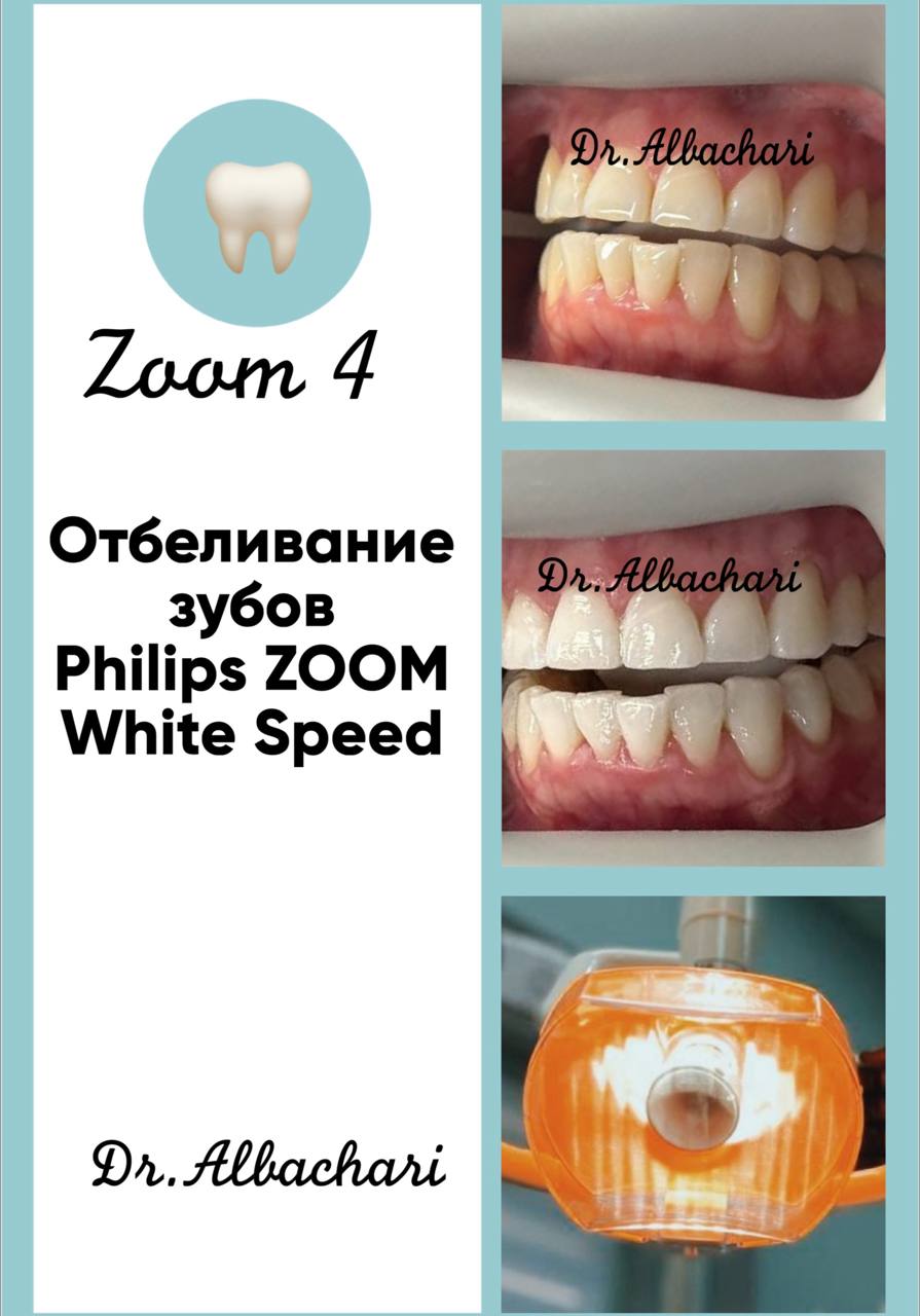 До и после комплексной чистки и реставрации